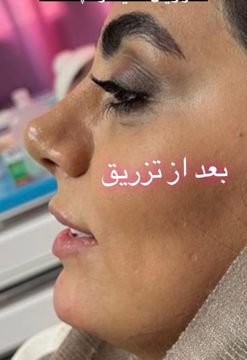 بعد از تزریق فیلر چانه