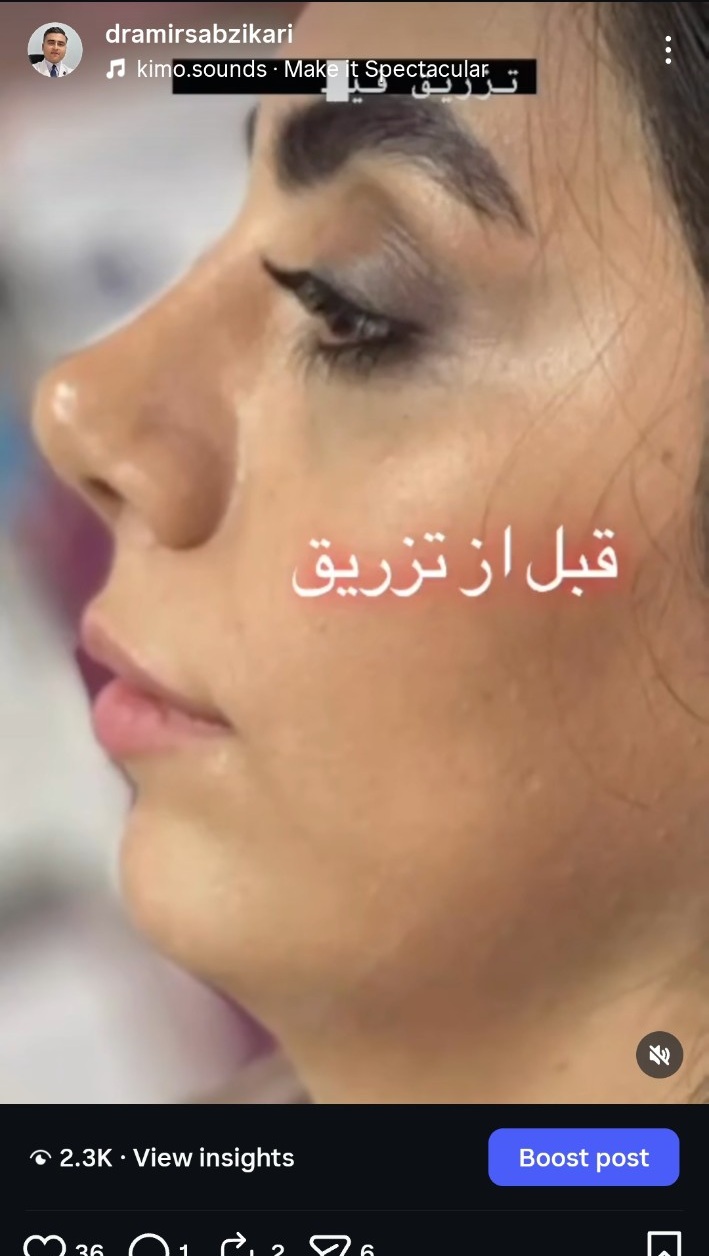 قبل از تزریق فیلر چانه